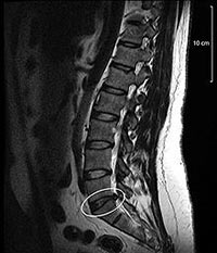 Bandscheibenprotrusion