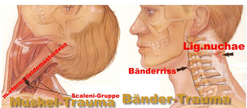 Symptome eines Schleudertraumas